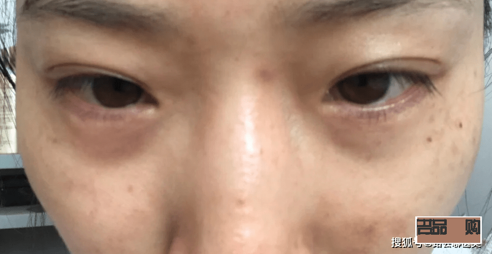 眼睛周围凹陷怎么恢复饱满的方法(眼睛周围凹陷怎么恢复饱满的方法图片)