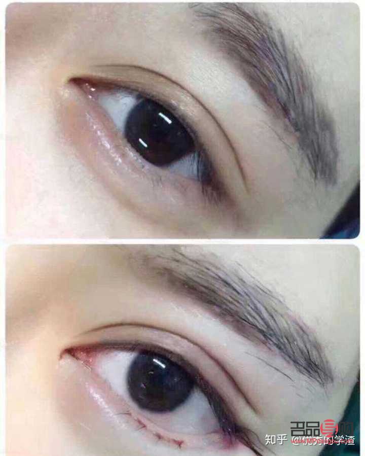 现在流行什么双眼皮手术(现在流行什么双眼皮手术效果好)