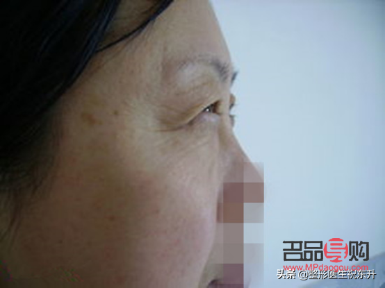 一单一双眼皮可以割双眼皮吗(一单一双可以做双眼皮手术吗)