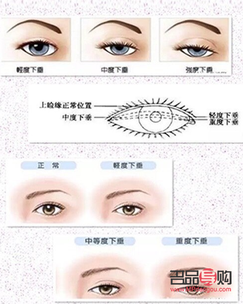 上睑下垂做双眼皮可以改变吗(上睑下垂做双眼皮可以改变吗)