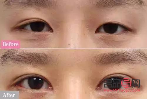 两个眼皮不一样怎么回事(两个眼皮不一样怎么回事儿) 两个眼皮不一样怎么回事(两个眼皮不一样怎么回事儿)