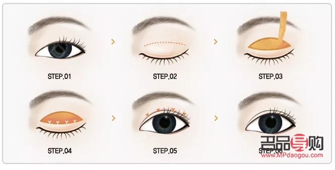 免麻双眼皮操作全解析