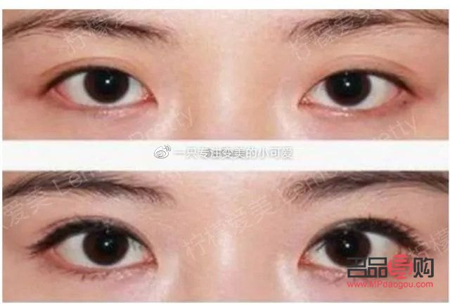 新月型双眼皮是否显老气？图片解析与探讨
