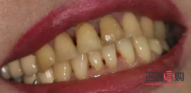 牙尖怎么美容的(牙尖怎么办有什么小妙招) 牙尖怎么美容的(牙尖怎么办有什么小妙招)
