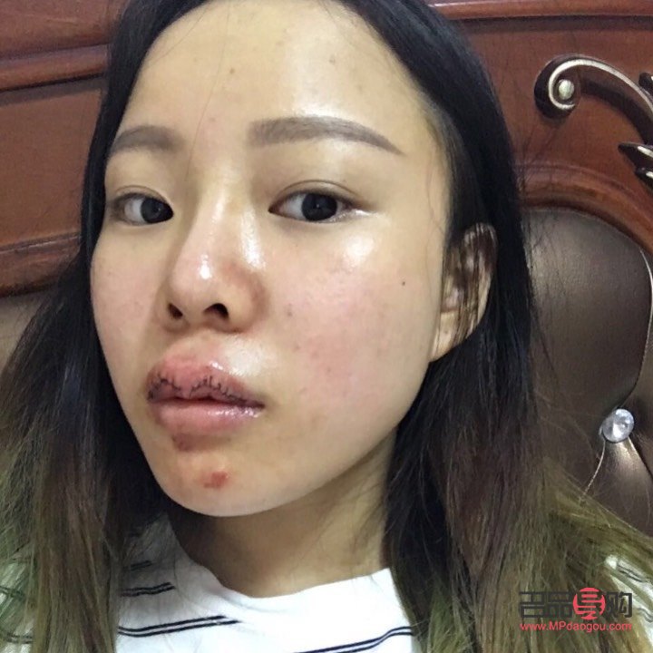 美容可以切嘴唇吗(美容可以切嘴唇吗图片)