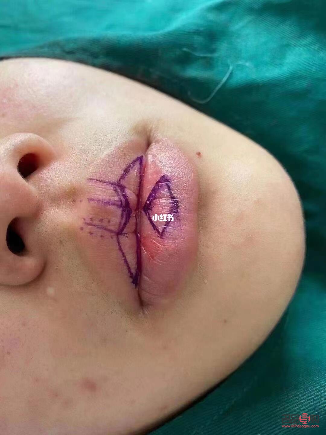 美容可以切嘴唇吗(美容可以切嘴唇吗图片)