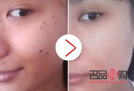哪家美容点痣(哪家美容点痣比较好)