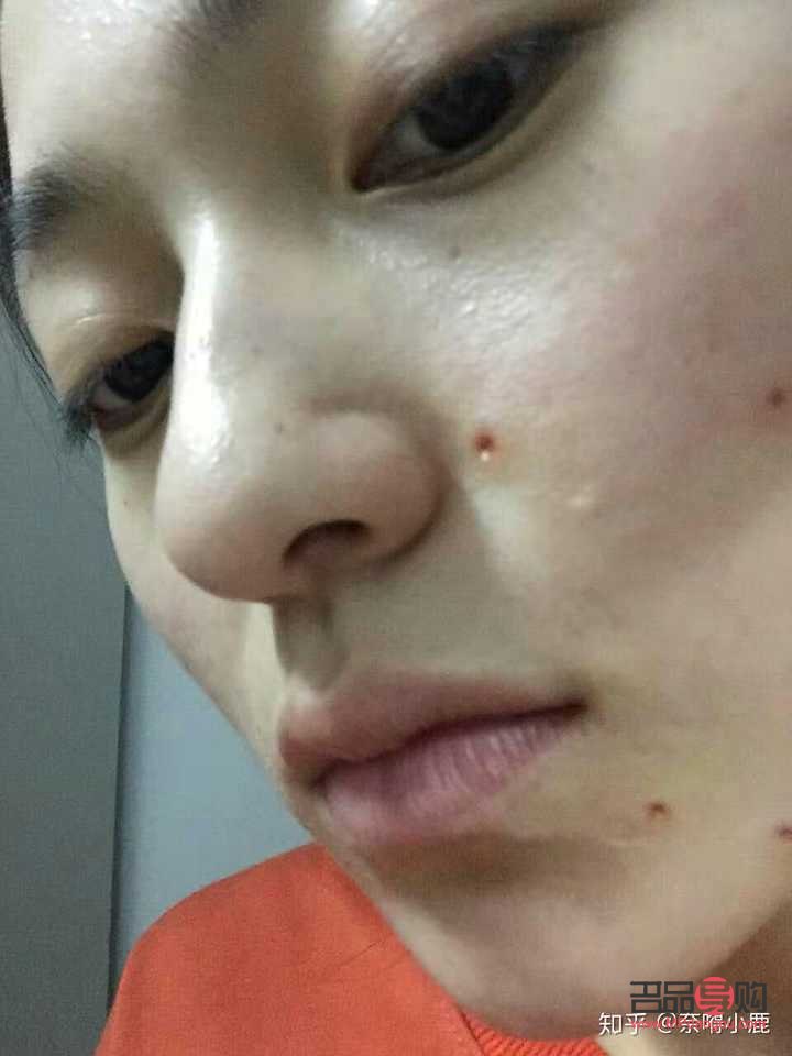 哪家美容点痣(哪家美容点痣比较好)