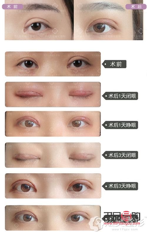 双眼皮成功的案例有哪些(双眼皮成功的案例有哪些)