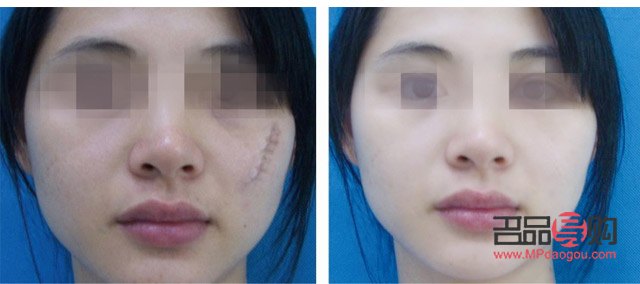 <h3>美容针能否完全去除疤痕？</h3>