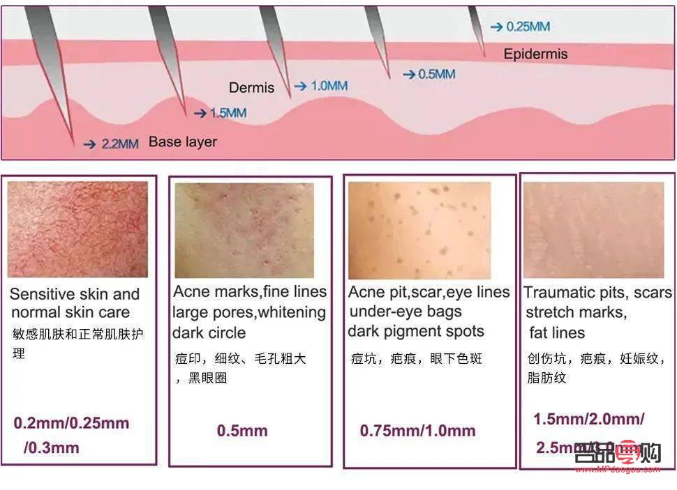 <h3>美容针能否完全去除疤痕？</h3>