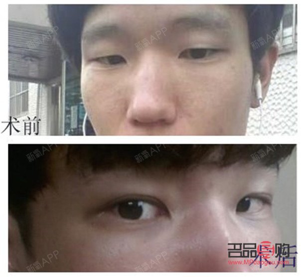 <h3>大小眼手术可能带来的后遗症</h3> <h3>大小眼手术可能带来的后遗症</h3>