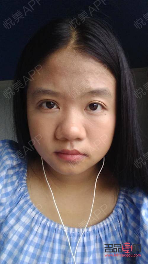 <h3>大小眼手术可能带来的后遗症</h3> <h3>大小眼手术可能带来的后遗症</h3>