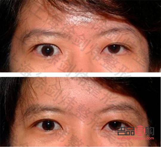 <h3>大小眼手术可能带来的后遗症</h3> <h3>大小眼手术可能带来的后遗症</h3>