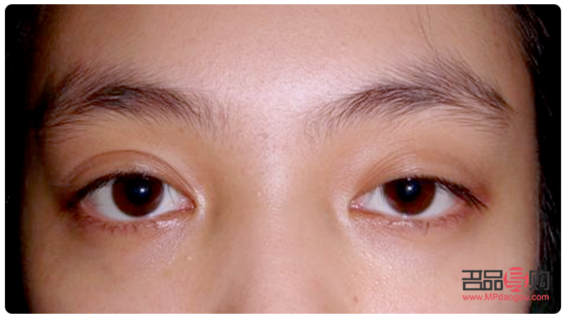 改善近视：针对一双一单眼睛的独特策略