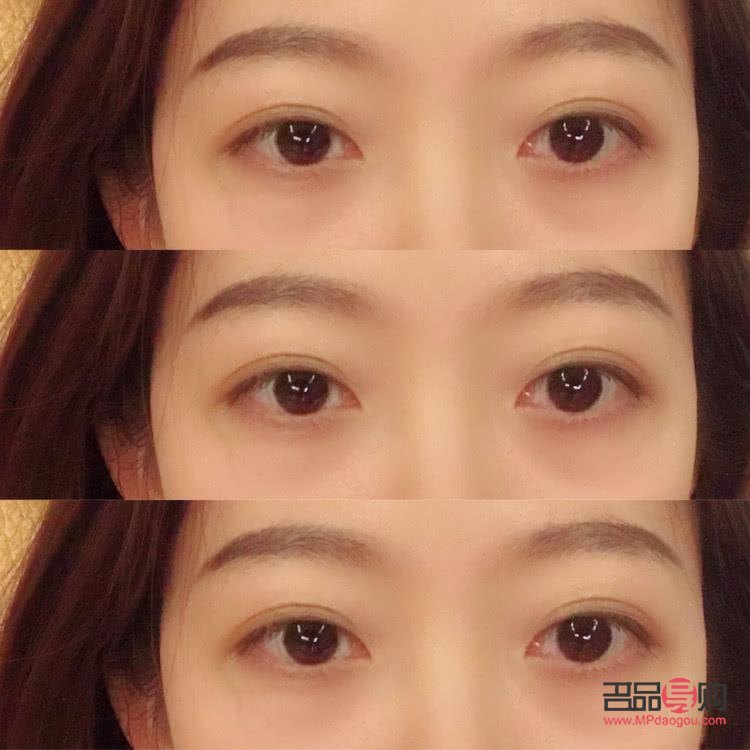 双眼皮手术有几种款式图片(双眼皮手术有几种款式图片及价格)