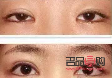 <h3>双眼皮成品图片真实展示：魅力双眼的蜕变之旅</h3>