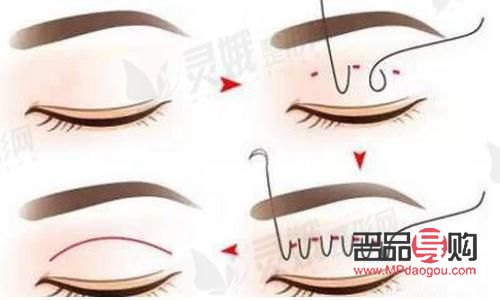 双眼皮太宽如何巧妙变窄？专业技巧大揭秘