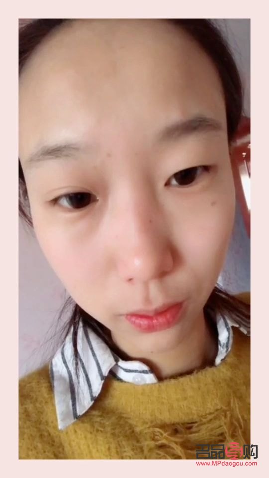 双眼皮宽了怎么补救视频(双眼皮宽了怎么补救视频教程)