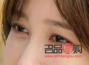 <h3>40岁眼皮松弛下垂：探寻最佳解决方案</h3>