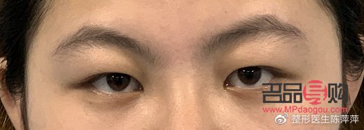 肿眼泡是怎么回事？