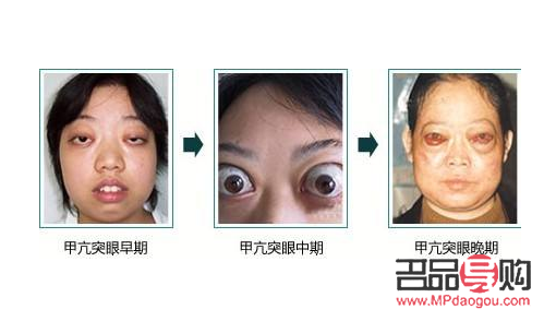 甲亢眼睛凸怎么改善(甲亢眼睛凸怎么治)