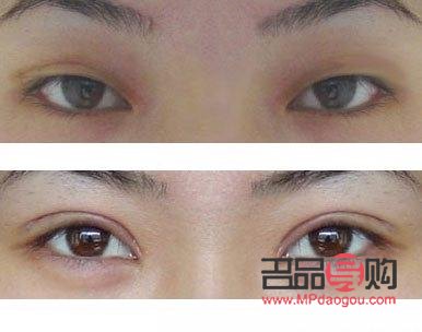 双眼皮手术的后遗症有哪些(双眼皮手术的后遗症有哪些症状)
