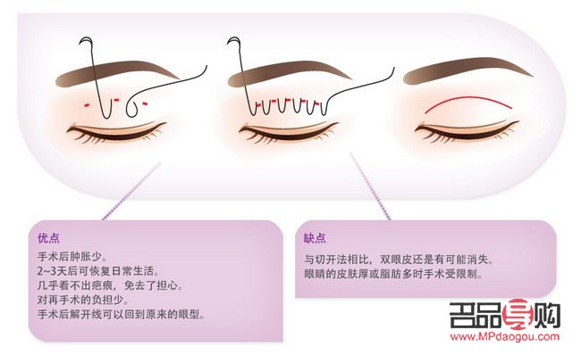 双眼皮贴引起的过敏红肿问题解析