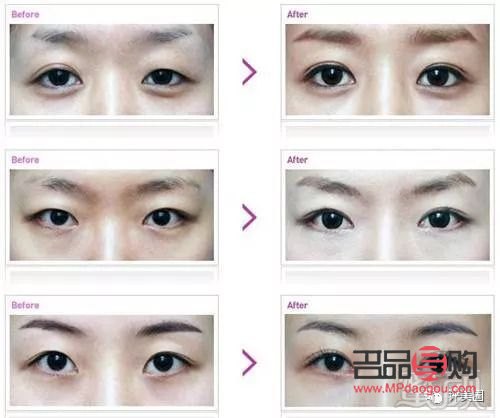 <h3>5G桃花眼双眼皮手术风险解析</h3>