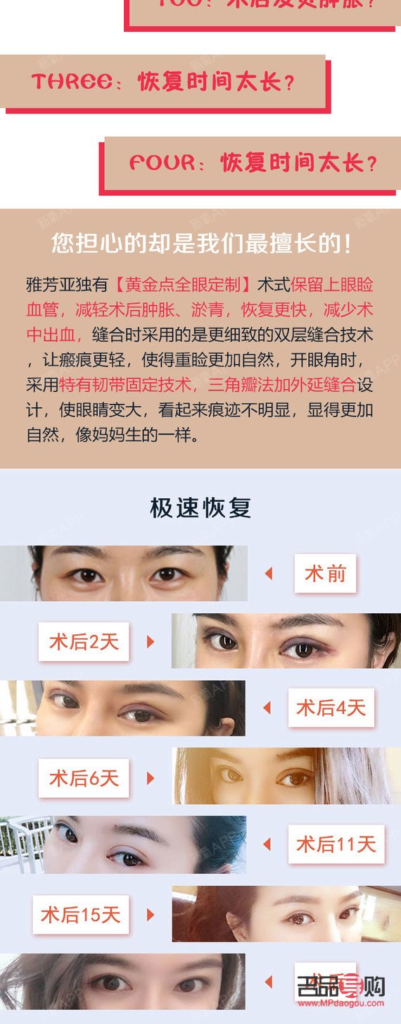 <h3>5G桃花眼双眼皮手术风险解析</h3>