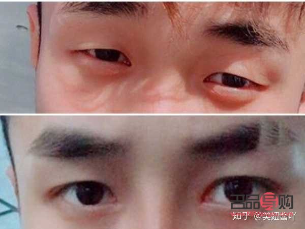 男生眼睛小怎么变大(男生眼睛小怎么变大不手术)