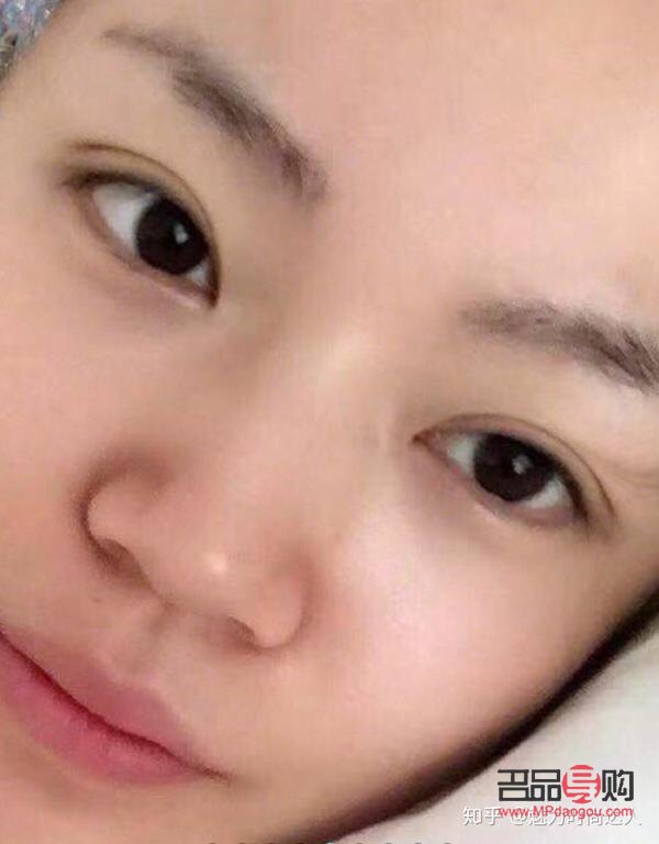 双眼皮逆袭成功(双眼皮逆袭成功率高吗)