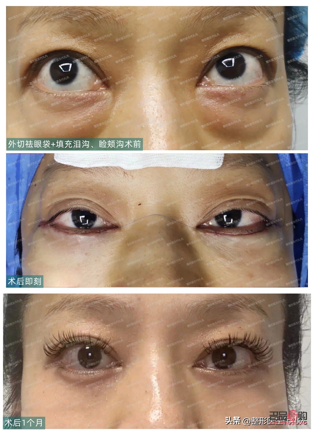 年龄大有眼袋如何办(年龄大有眼袋如何办消除) 年龄大有眼袋如何办(年龄大有眼袋如何办消除)