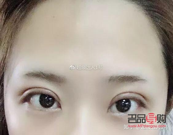 开扇双眼皮手术全解析 开扇双眼皮手术全解析