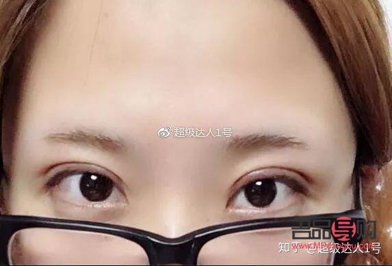 开扇双眼皮手术全解析