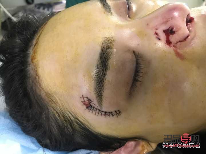 美容线怎么拆线(美容线怎么拆线示范)