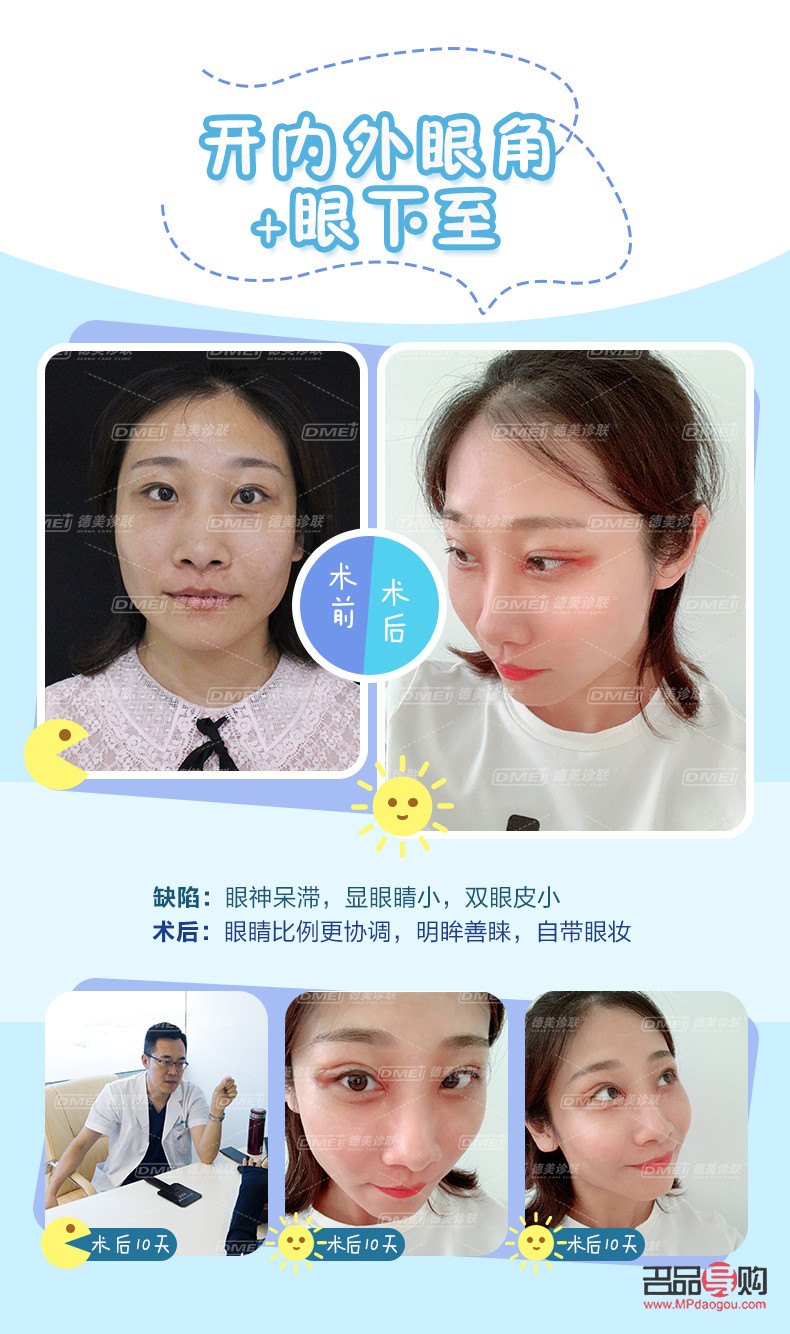 小眼睛开眼角双眼皮效果(小眼睛开眼角双眼皮效果好吗)
