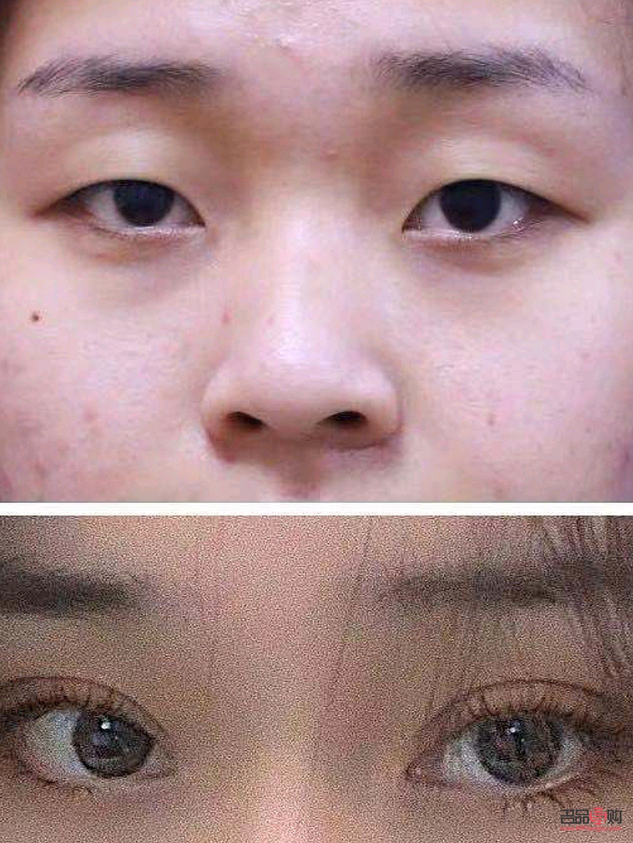 小眼睛开眼角双眼皮效果(小眼睛开眼角双眼皮效果好吗)