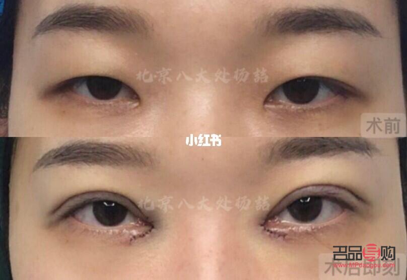 小眼睛开眼角双眼皮效果(小眼睛开眼角双眼皮效果好吗)