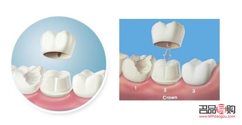 陶瓷美容冠怎么样(陶瓷美牙)