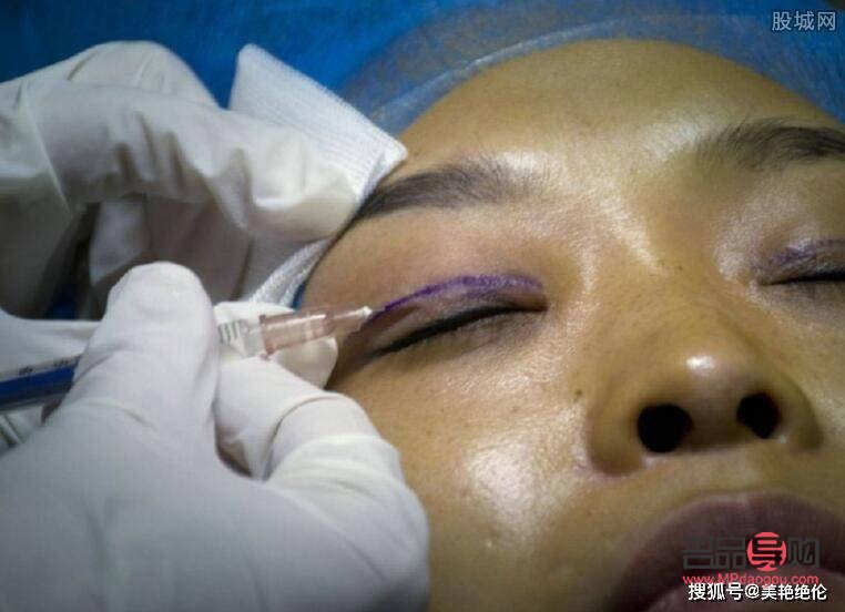 割双眼皮多久能恢复正常(割双眼皮多久能恢复正常饮食)