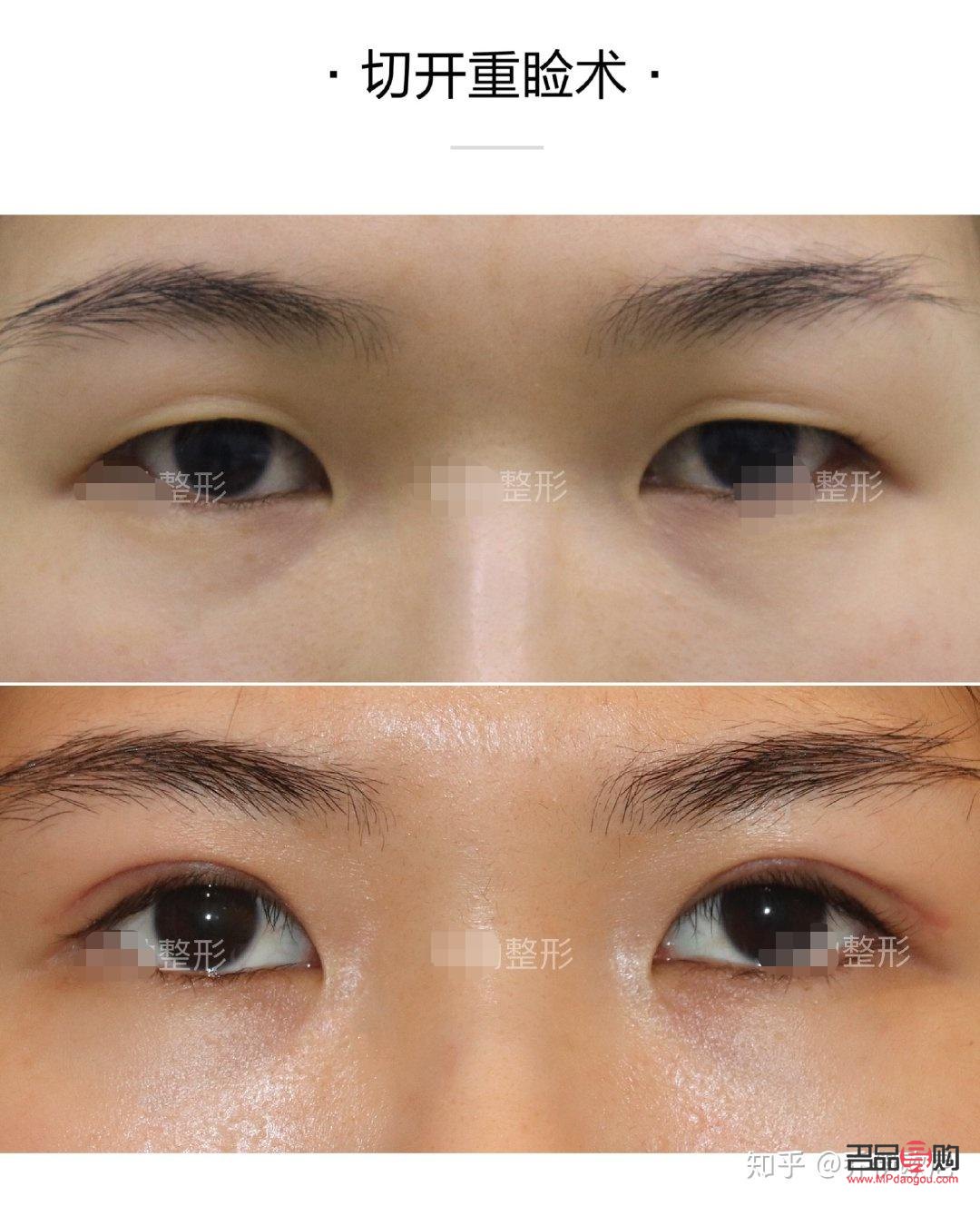 割双眼皮多久能恢复正常(割双眼皮多久能恢复正常饮食)