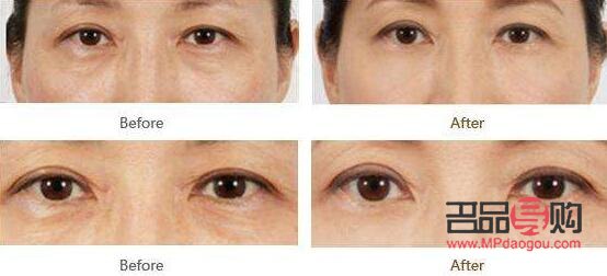 去眼袋多少钱标准收费(提眉术价格一般是多少)