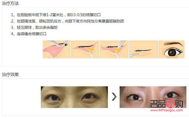 去眼袋多少钱标准收费(提眉术价格一般是多少)