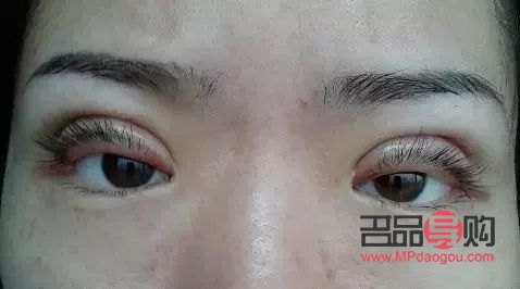 应对过敏引发的上眼皮红肿问题