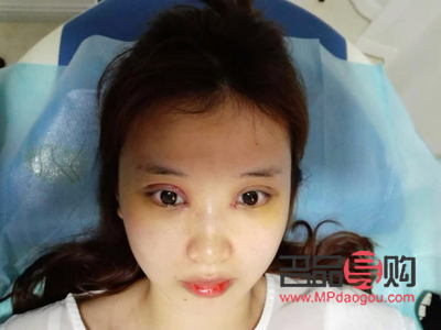 美容针拆线痛吗