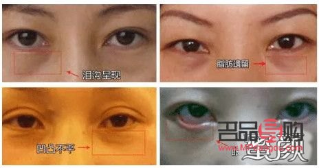 <h3>探究眼袋成因及治疗方法</h3>