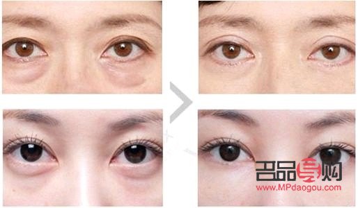 <h3>探究眼袋成因及治疗方法</h3>