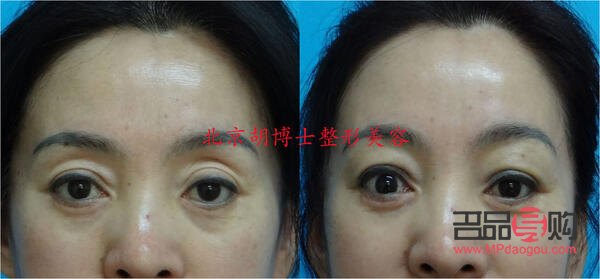 <h3>上眼睑凹陷改善方法大揭秘</h3>