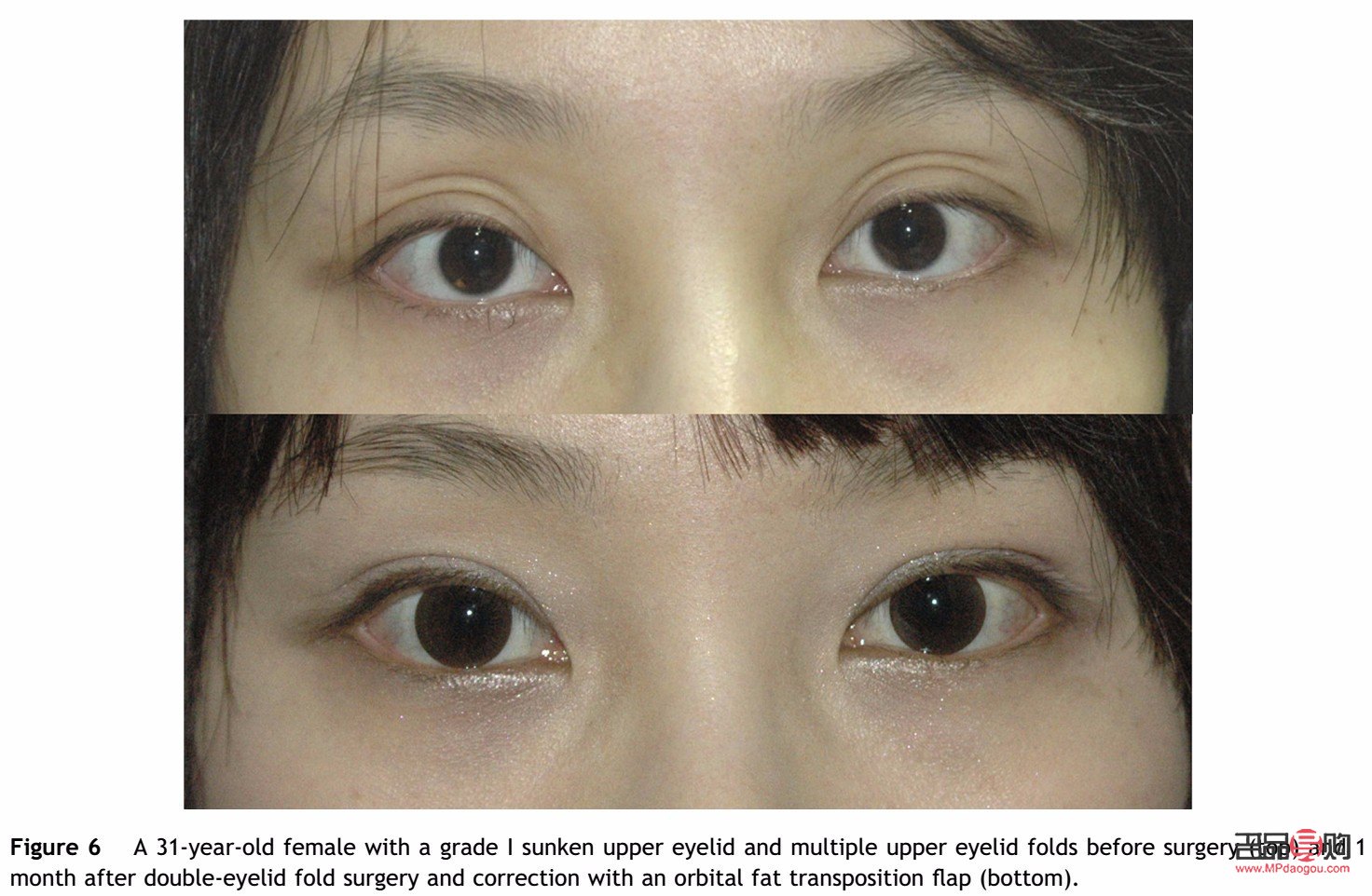 <h3>上眼睑凹陷改善方法大揭秘</h3>